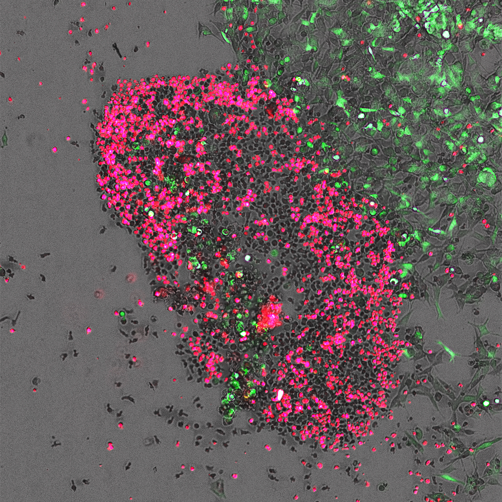 神经母细胞瘤癌细胞（绿色）被原代人天然杀伤细胞（红色）靶向和杀死，并在促降免疫调节剂治疗后。使用两个通道荧光和Brightfield成像在10倍下使用细胞成像进行实时细胞成像。