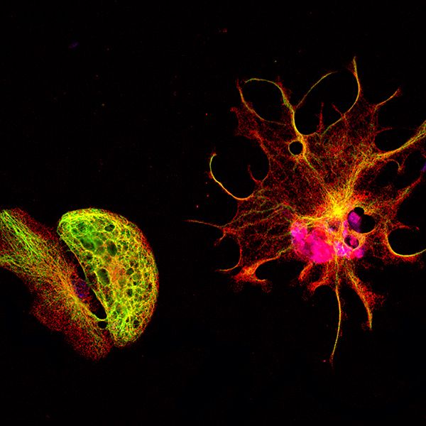 MAP2（红色）和GFAP（绿色）在间充质干细胞上染色的体外神经分化诱导；放大倍数40倍。